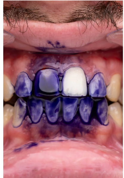 PURPLE V34 - Blanqueador Dental